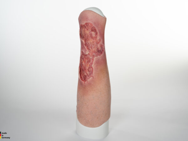 Sleeve Bein mit Gamaschenulkus – Bild 5