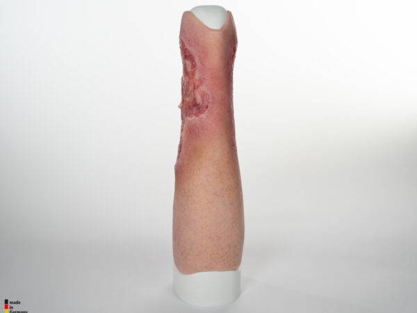 Sleeve Bein mit Gamaschenulkus – Bild 7