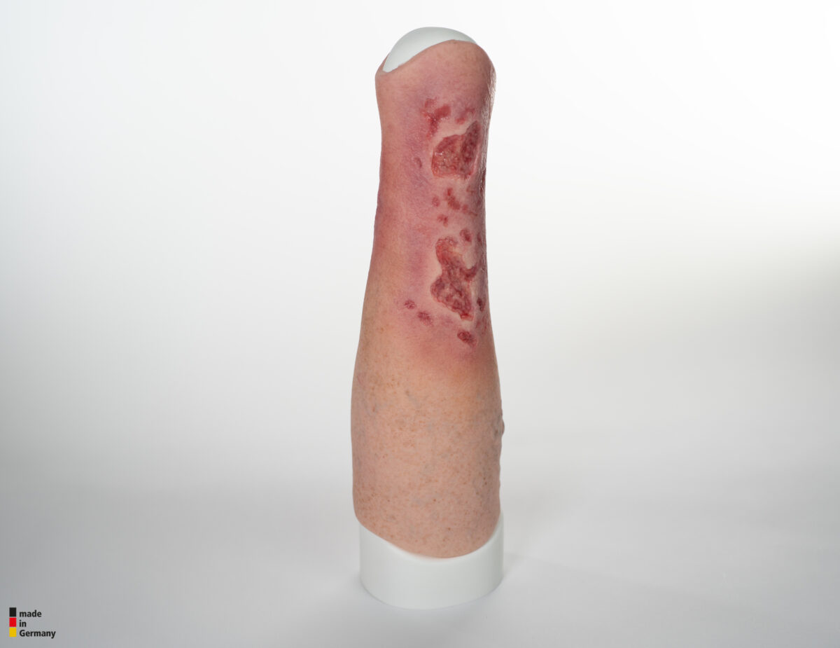 Sleeve Bein mit Gamaschenulkus