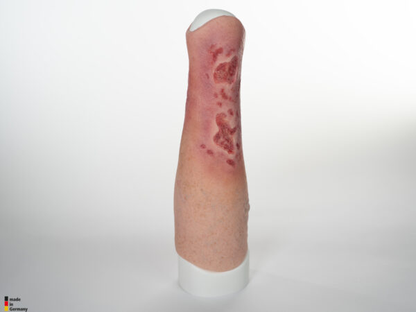 Sleeve Bein mit Gamaschenulkus – Bild 6