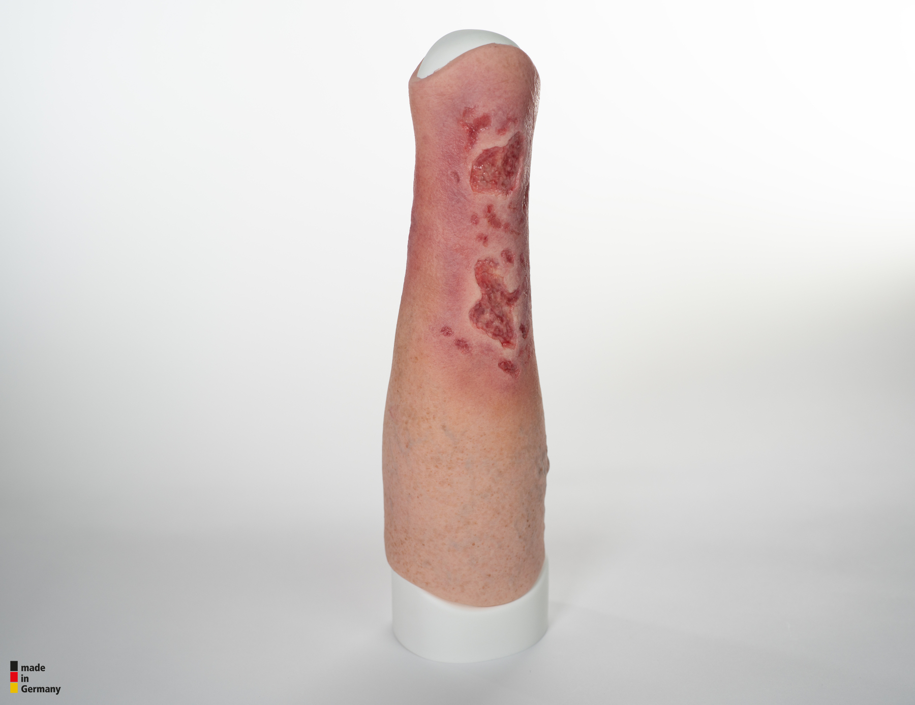 Sleeve Bein mit Gamaschenulkus – Bild 6