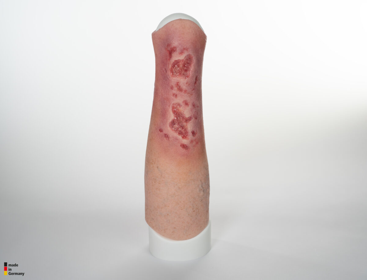 Sleeve Bein mit Gamaschenulkus
