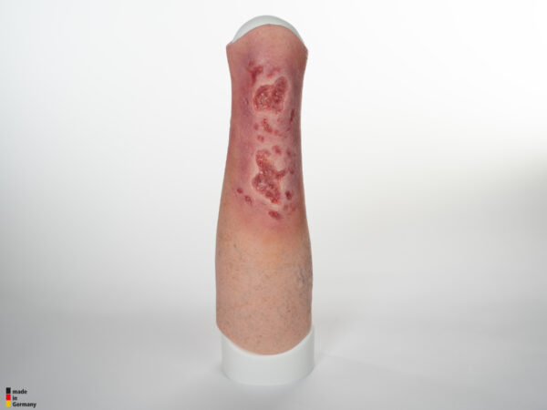 Sleeve Bein mit Gamaschenulkus – Bild 8