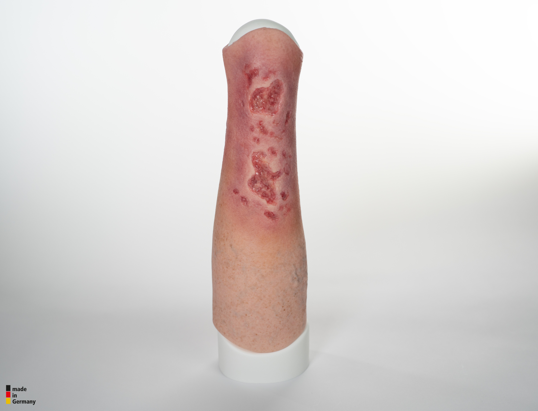 Sleeve Bein mit Gamaschenulkus – Bild 8