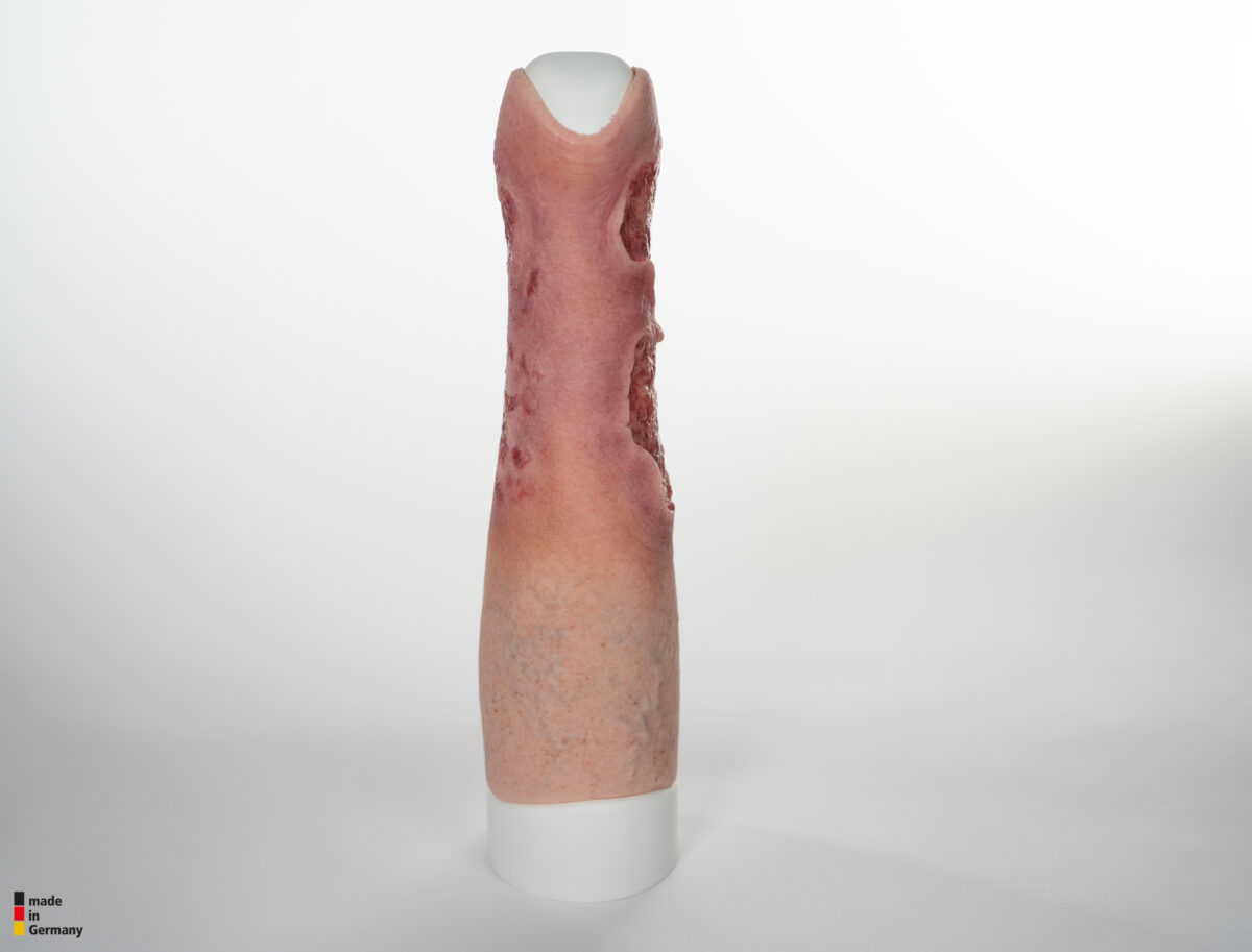 Sleeve Bein mit Gamaschenulkus
