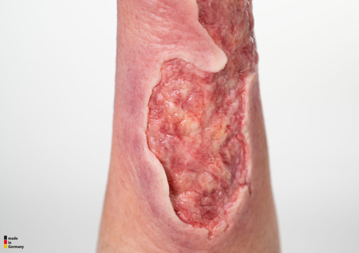 Sleeve Bein mit Gamaschenulkus