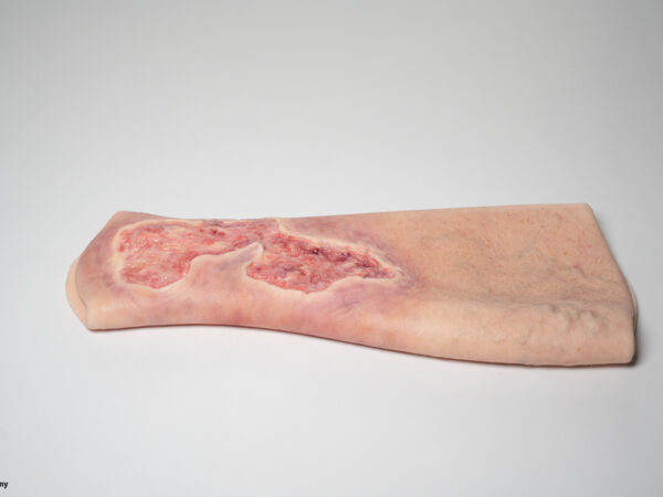 Sleeve Bein mit Gamaschenulkus – Bild 2