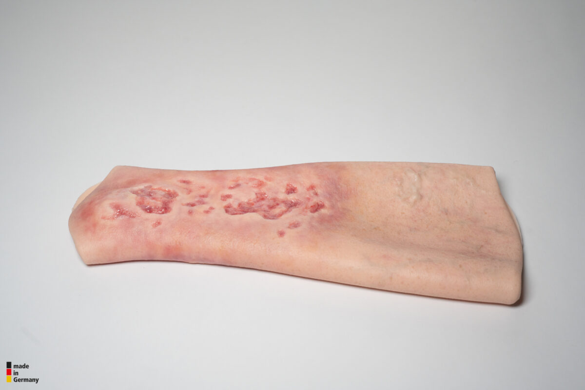 Sleeve Bein mit Gamaschenulkus