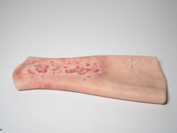 Sleeve Bein mit Gamaschenulkus – Bild 3
