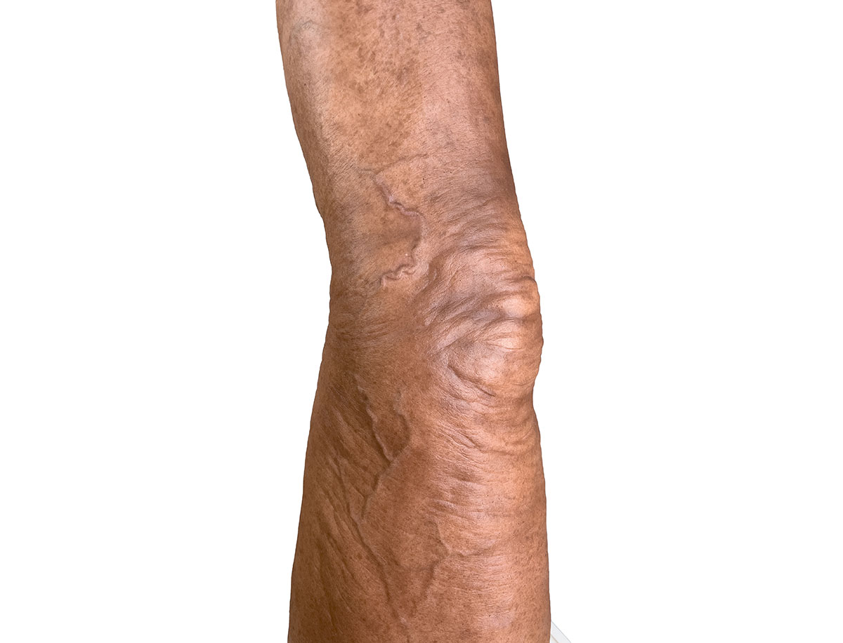 Sockelmodell Bein mit 7 flachen Wunden