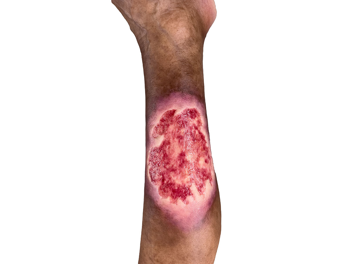 Sockelmodell Bein mit 7 flachen Wunden