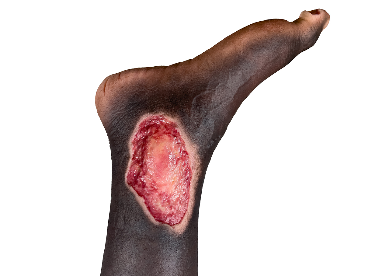 Sockelmodell Bein mit 7 tiefen Wunden