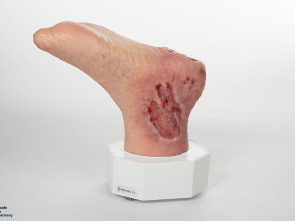 Sockelmodell Diabetisches Fußsyndrom mit 7 Wunden – Bild 8