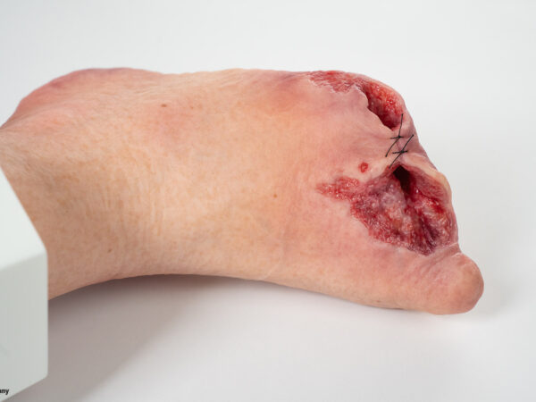 Sockelmodell Diabetisches Fußsyndrom mit 7 Wunden – Bild 7