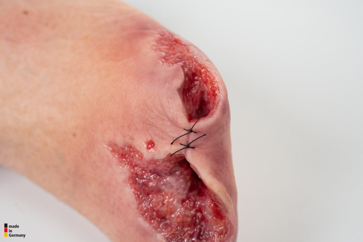 Sockelmodell Diabetisches Fußsyndrom mit 7 Wunden