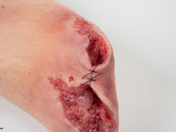 Sockelmodell Diabetisches Fußsyndrom mit 7 Wunden – Bild 2