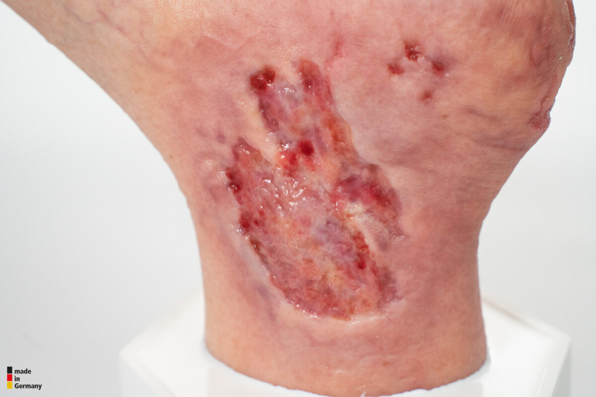 Sockelmodell Diabetisches Fußsyndrom mit 7 Wunden