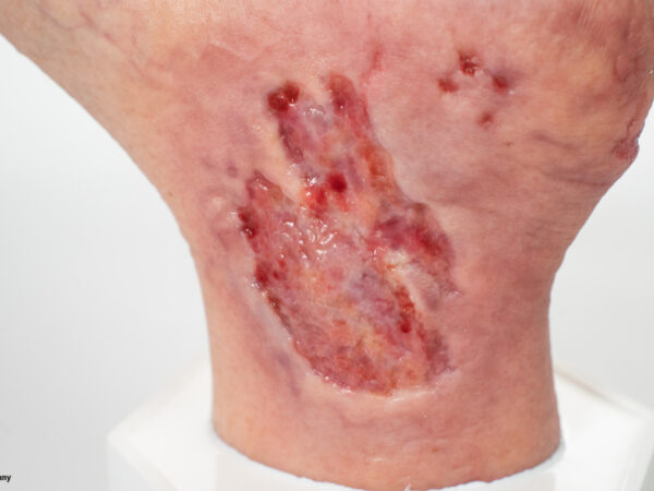 Sockelmodell Diabetisches Fußsyndrom mit 7 Wunden – Bild 6