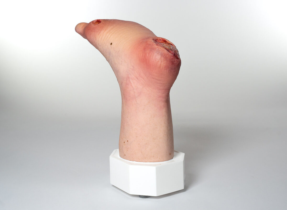 Wundmodell Fußmodell Amputation der Zehen