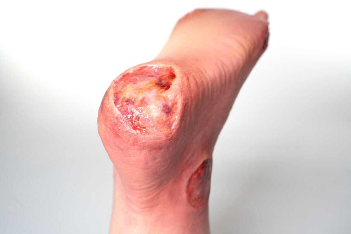 Fußmodell Ferse Silikonmodell mit chronischer Wunde