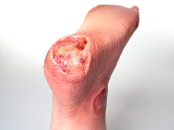 Fußmodell Ferse Silikonmodell mit chronischer Wunde