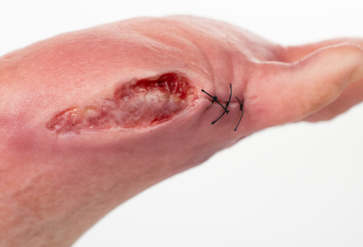 Fußmodell Zehenampotation Detail der Wunde. Modell aus Silikon