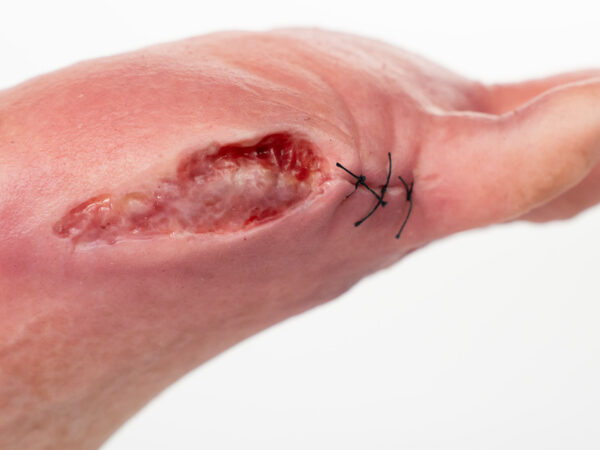 Fußmodell Zehenampotation Detail der Wunde. Modell aus Silikon