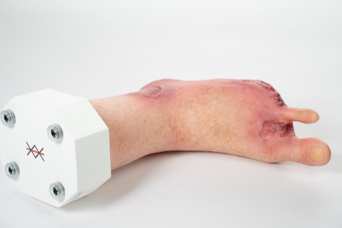 Silikonmodell auf einem Sockel. Fußmodell mit Amputationen