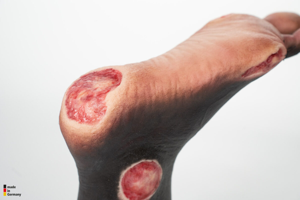 Sockelmodell Zwei-Zehen-Fuß mit 6 Wunden