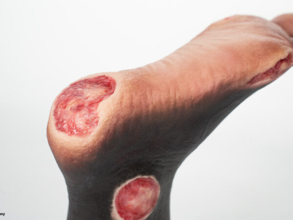 Sockelmodell Zwei-Zehen-Fuß mit 6 Wunden – Bild 17