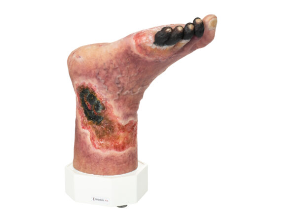 Base Model Necrotic Foot