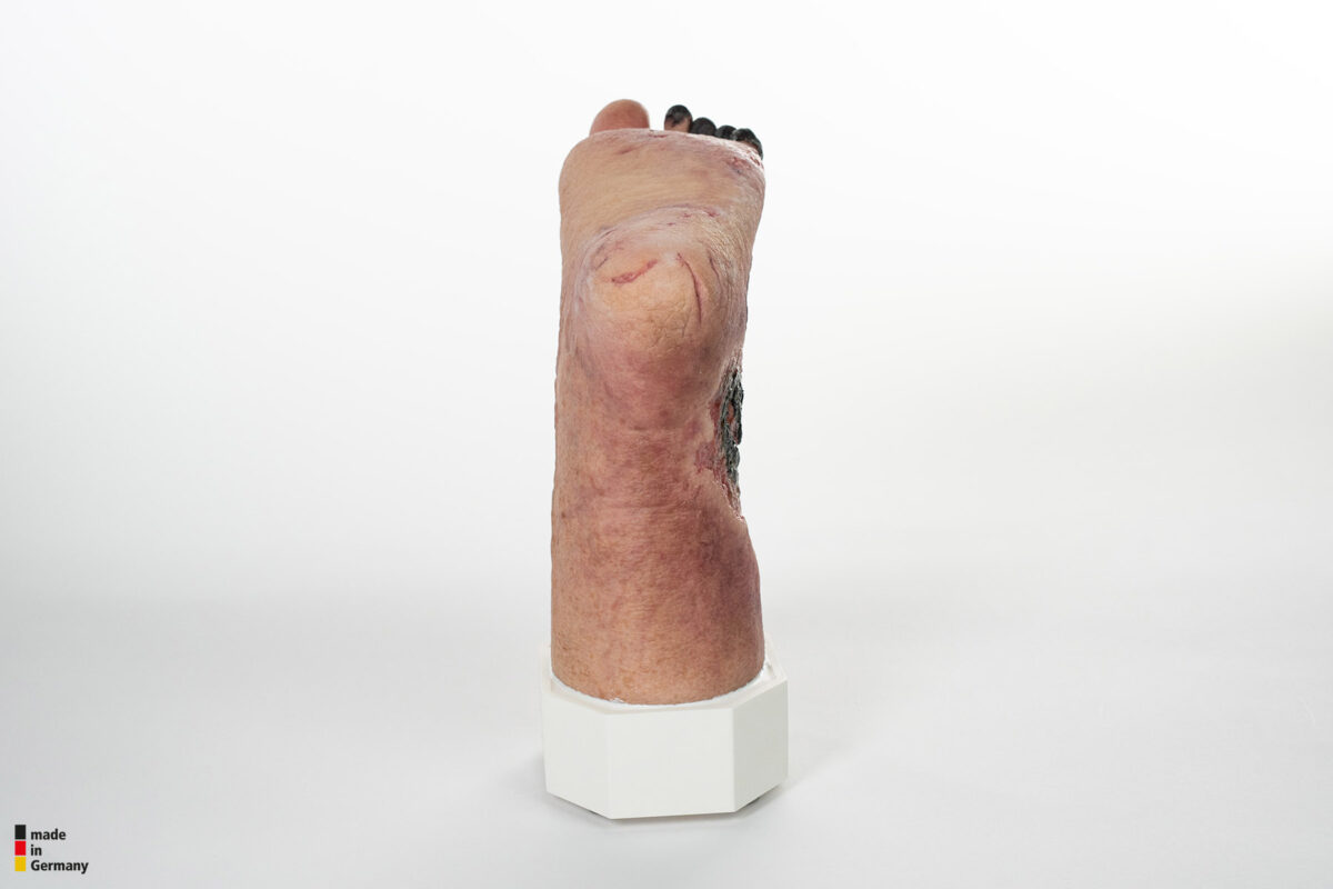 Sockelmodell Nekrotischer Fuß