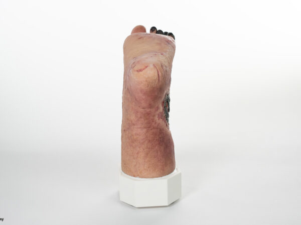 Sockelmodell Nekrotischer Fuß – Bild 6