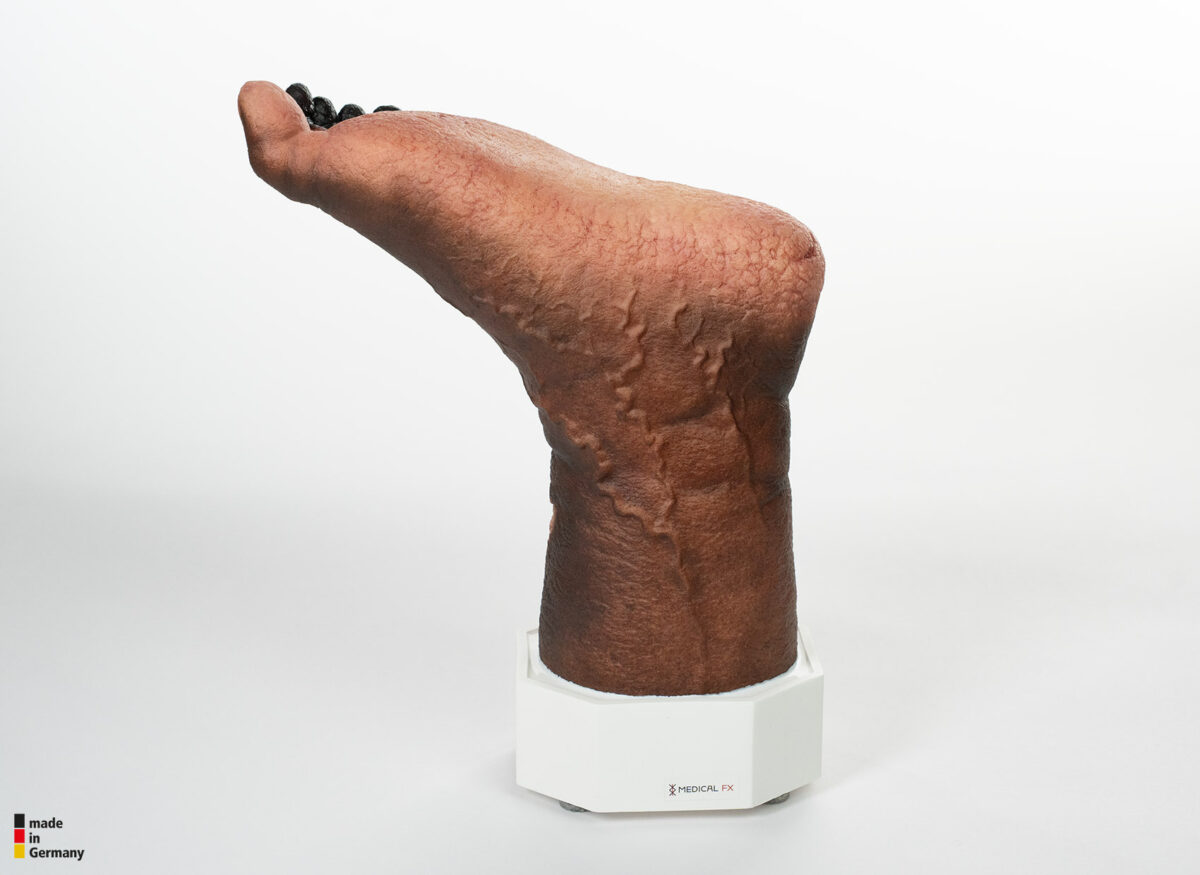 Sockelmodell Nekrotischer Fuß