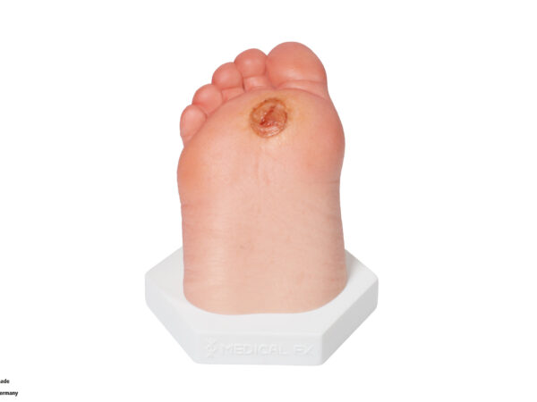 Base Model Diabetic Foot Ulcer (DFU), Stage 1, Forefoot