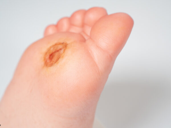 Diabetischer Fuß Ulcer (DFU), Stadium 1, Vorfuß – Bild 2