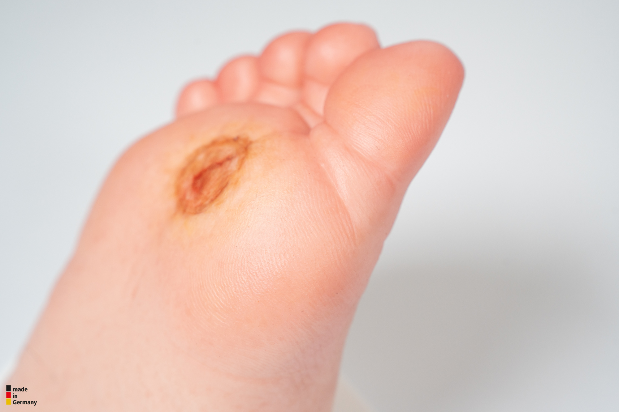 Diabetischer Fuß Ulcer (DFU), Stadium 1, Vorfuß – Bild 2