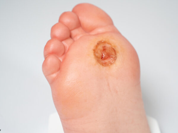 Diabetischer Fuß Ulcer (DFU), Stadium 1, Vorfuß – Bild 7