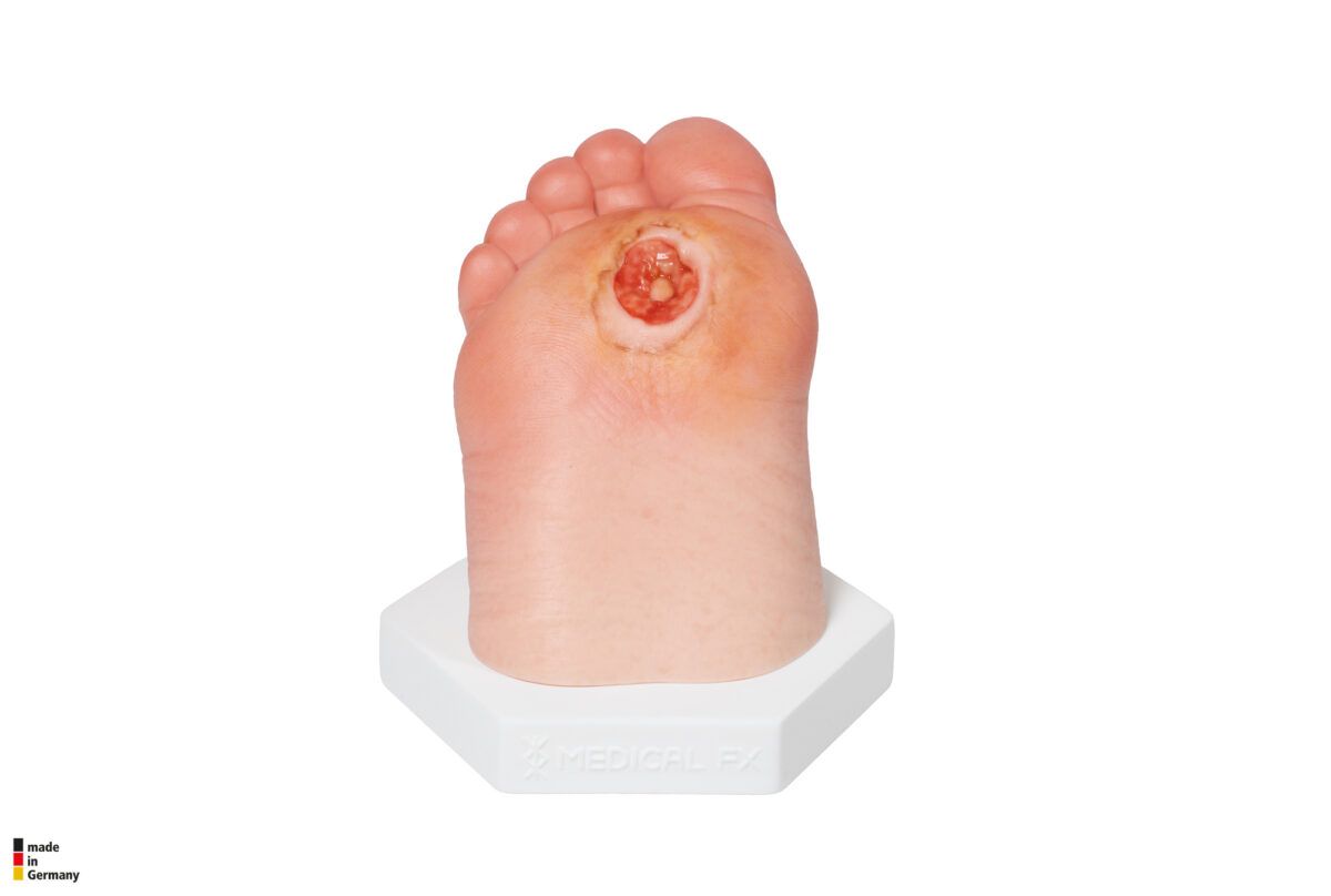 Diabetischer Fuß Ulcer (DFU), Stadium 3, Vorfuß