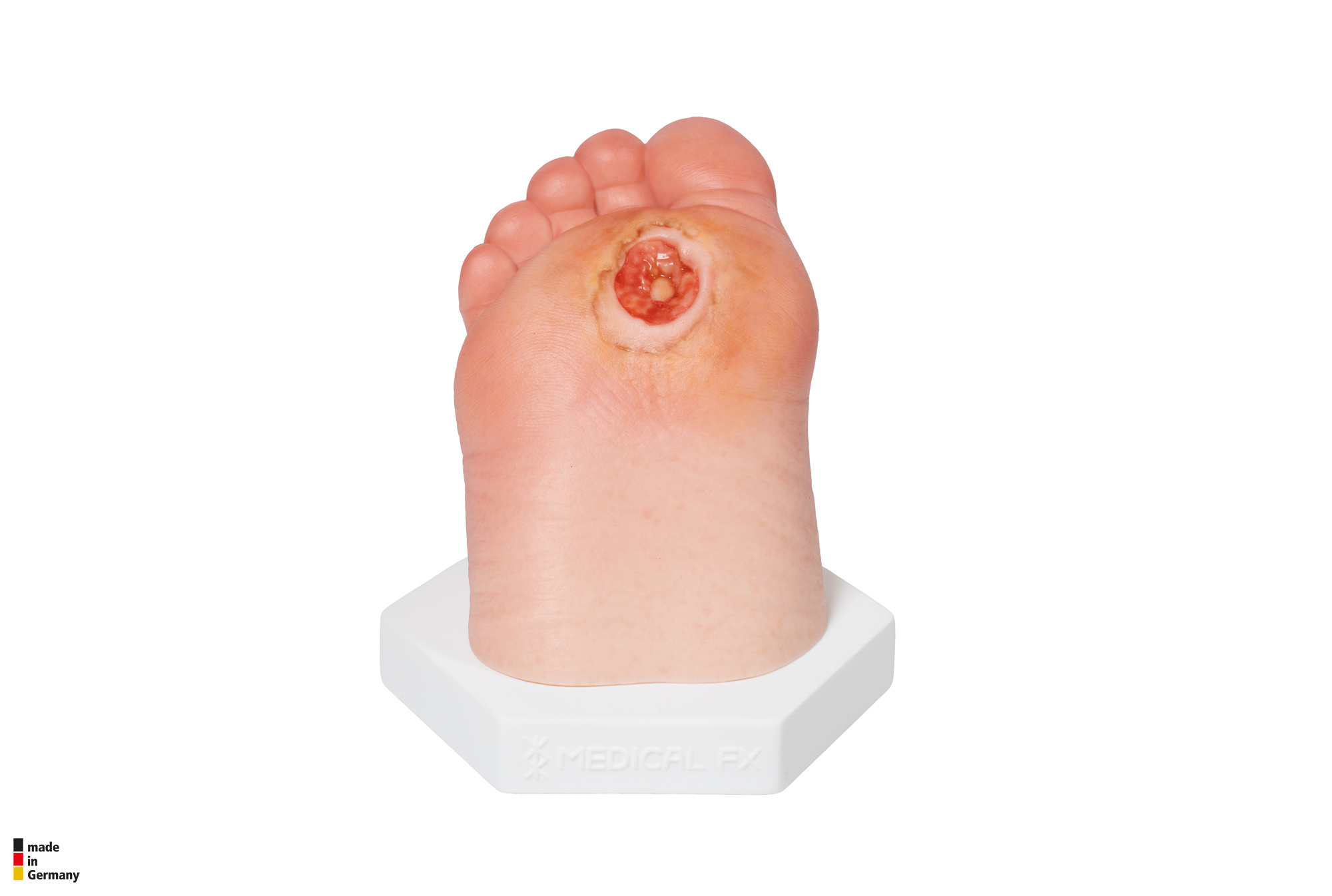 Diabetischer Fuß Ulcer (DFU), Stadium 3, Vorfuß