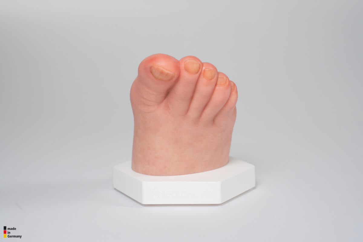 Base Model Diabetic Foot Ulcer (DFU), Stage 3, Forefoot