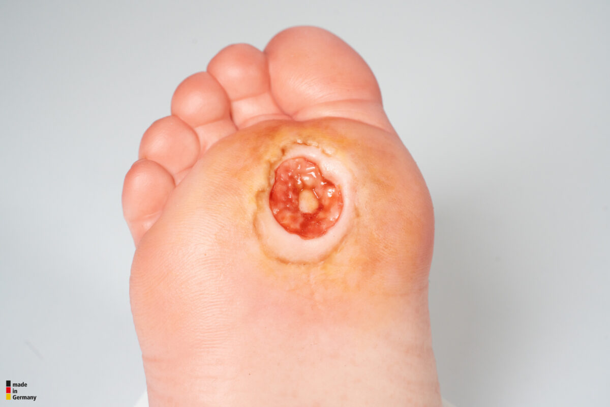 Base Model Diabetic Foot Ulcer (DFU), Stage 3, Forefoot
