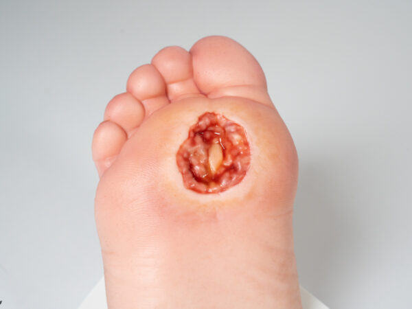 Diabetischer Fuß Ulcer (DFU), Stadium 4, Vorfuß – Bild 2