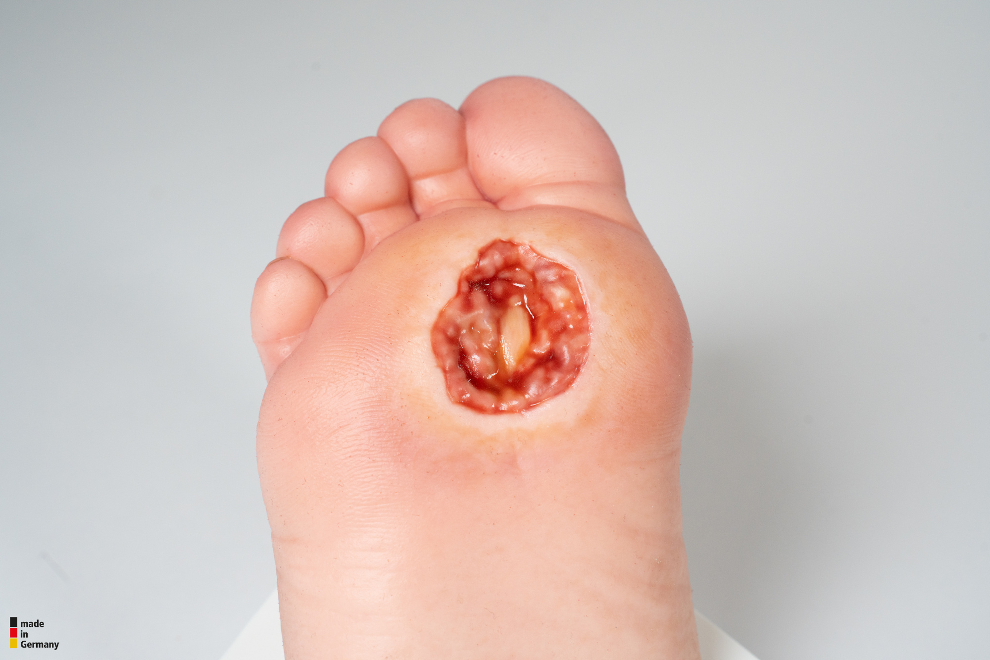 Diabetischer Fuß Ulcer (DFU), Stadium 4, Vorfuß – Bild 2