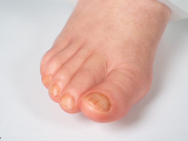 Diabetischer Fuß Ulcer (DFU), Stadium 4, Vorfuß – Bild 6