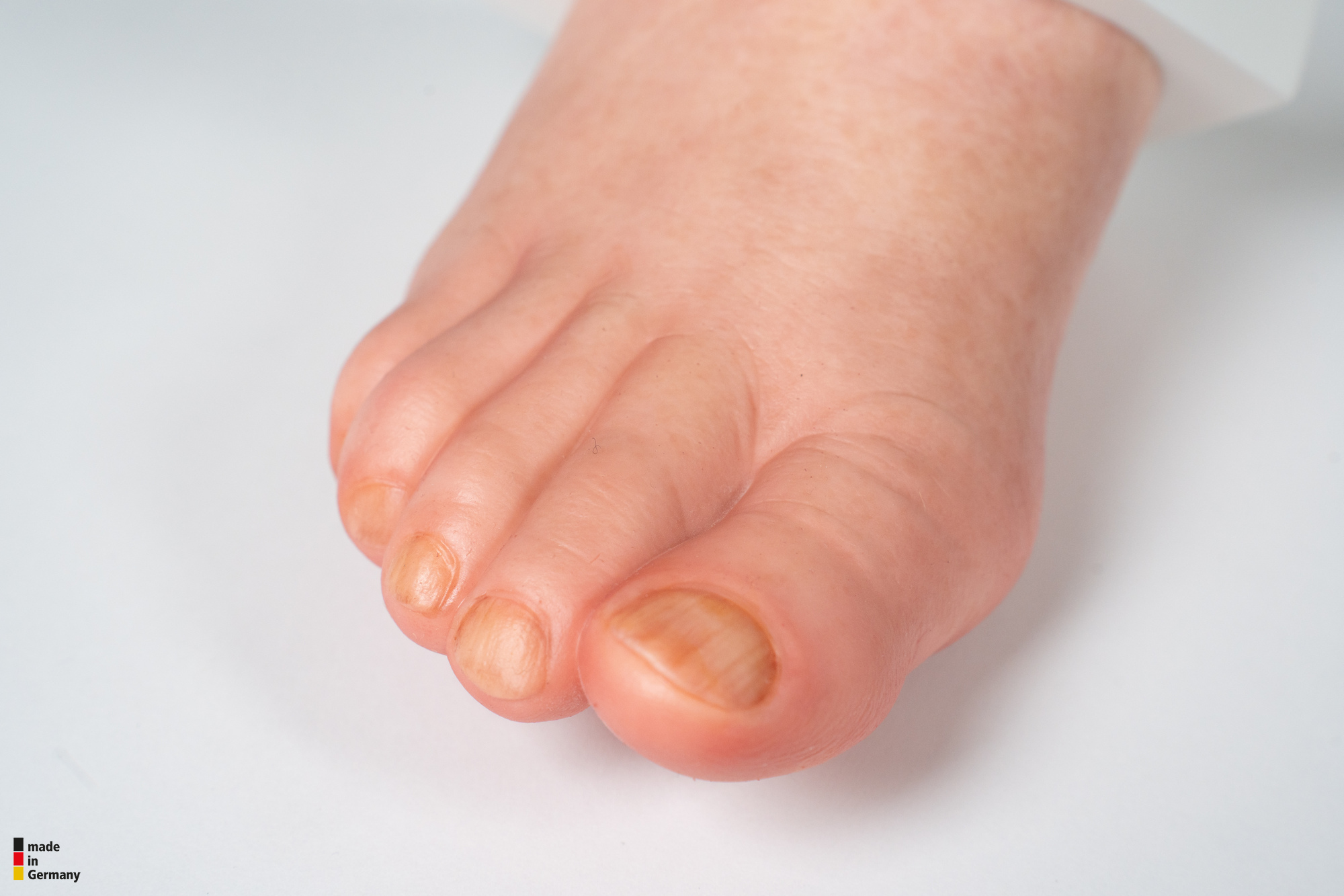 Diabetischer Fuß Ulcer (DFU), Stadium 4, Vorfuß – Bild 6