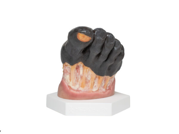 Diabetic Foot Ulcer (DFU), Stage 5 with Necrosis, Forefoo