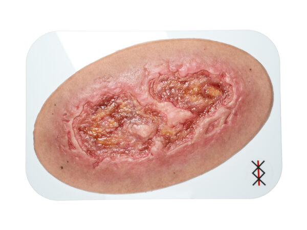 Stick-On Large Ulcus Cruris