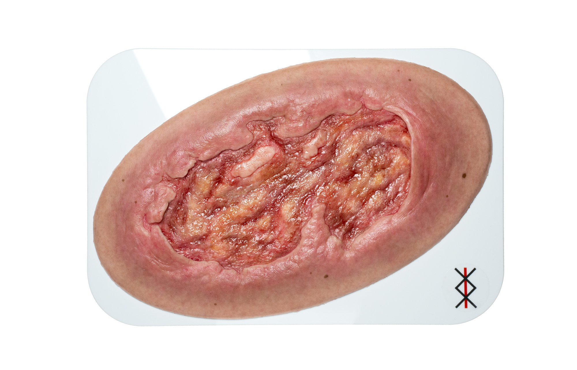 Stick-On Large Ulcer mit Unterminierung – Bild 1