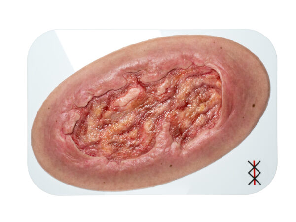 Stick-On Large Ulcer mit Unterminierung – Bild 3